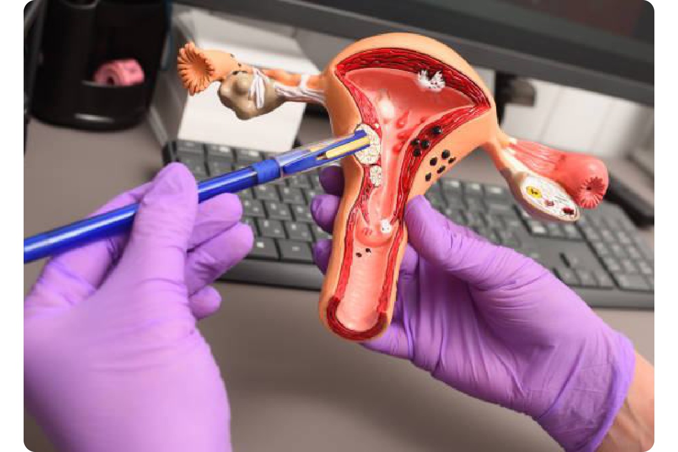 Detección del cáncer cervicouterino