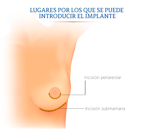 Ilustraci�n de los lugares en donde se hace la incisi�n para introducir el implante mamario.