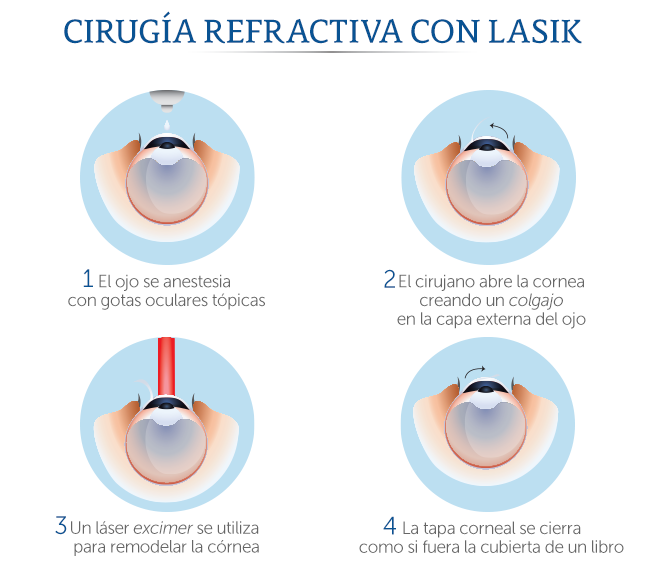 Esquema de cirug�a con Lasik