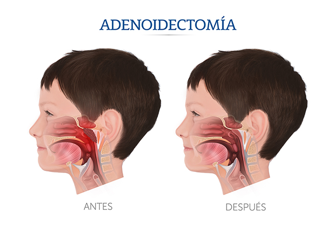 Iustraci�n sobre la adenoidectom�a