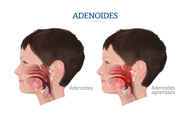 Ilustraci�n del lugar que ocupan las adenoides