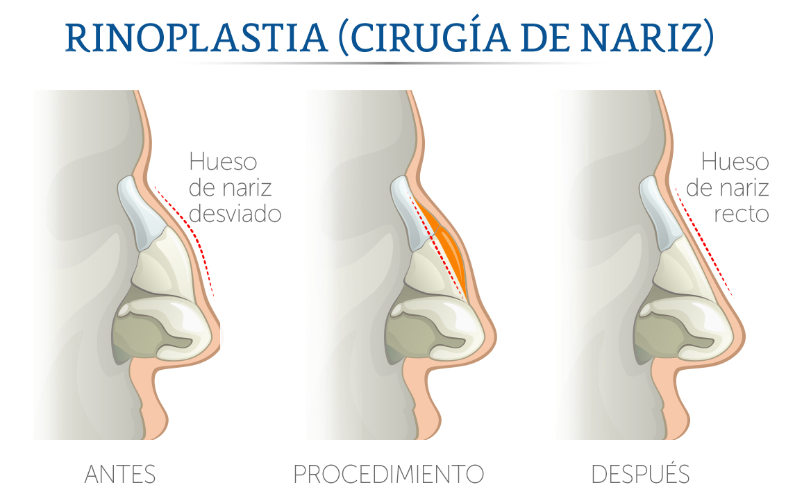 Ilustraci�n de una cirug�a de nariz