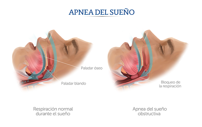 Ilustraci&oacute;n de apnea de sue&ntilde;o y respiraci&oacute;n normal.