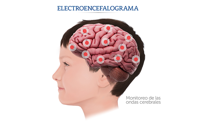 Infograf&iacute;a sobre el electroencefalograma