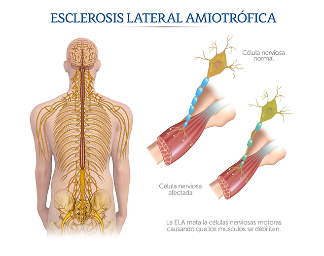 Ilustraci�n de la Esclerosis Lateral Atr�fica
