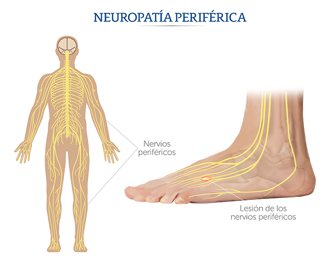 Nervios perif&eacute;ricos en la neuropat&iacute;a perif&eacute;rica