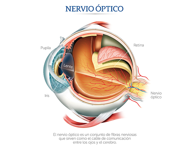 El nervio &oacute;ptico en la neuritis &oacute;ptica