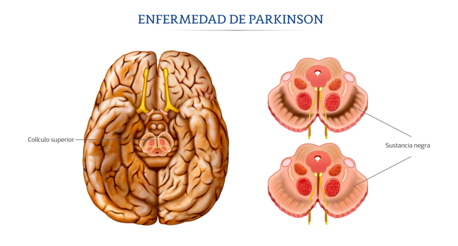 Ilustraci&oacute;n de cerebro en la enfermedad de Parkinson