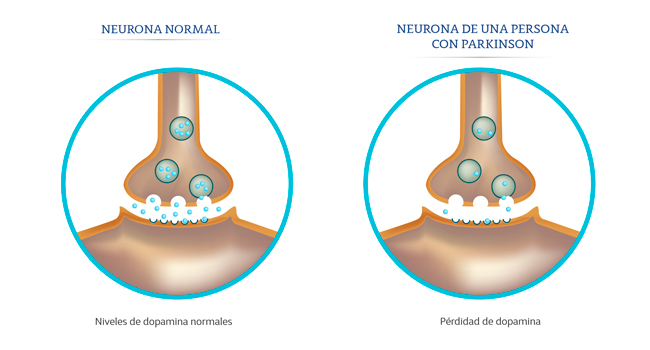 Ilustraci&oacute;n de una neuronas normal versus la neurona con Parkinson